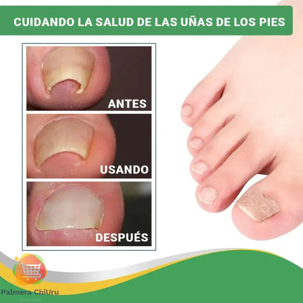 🩹 Hongo Stop. Parches para hongos uñas x 3 cajas de 16 unidades c/u.