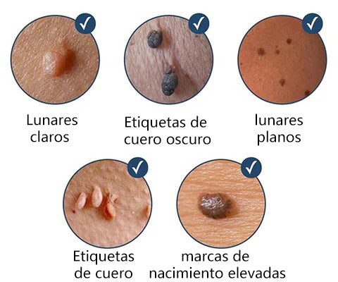 Parches Removedor de Verrugas y Lunares