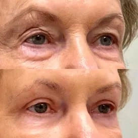 Contorno de Ojos con Colágeno + Ácido Hialurónico