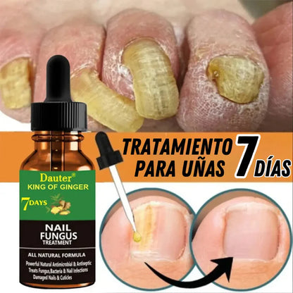 Serum para hongos en uñas | Dile adiós a los molestos hongos.