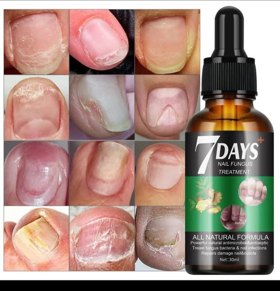 Serum para hongos en uñas | Dile adiós a los molestos hongos.
