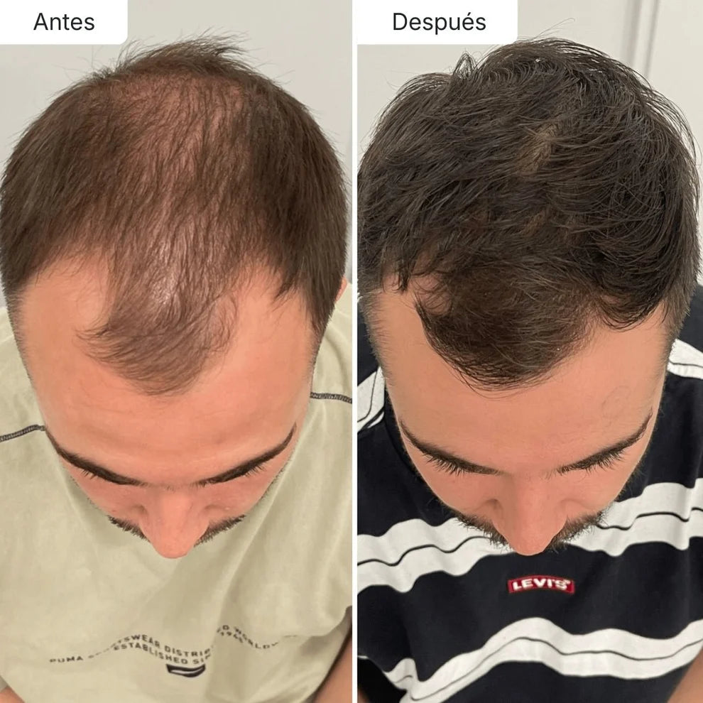 Sérum Anticaída de Doble Acción | Retoma tu pelo de hace años!