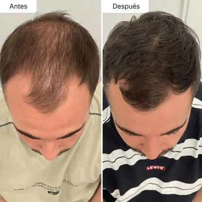 Sérum Anticaída de Doble Acción | Retoma tu pelo de hace años!