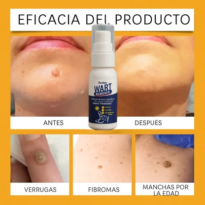Crema Removedora de Verrugas y Lunares Wart Remover | Elimina con suavidad y rapidez