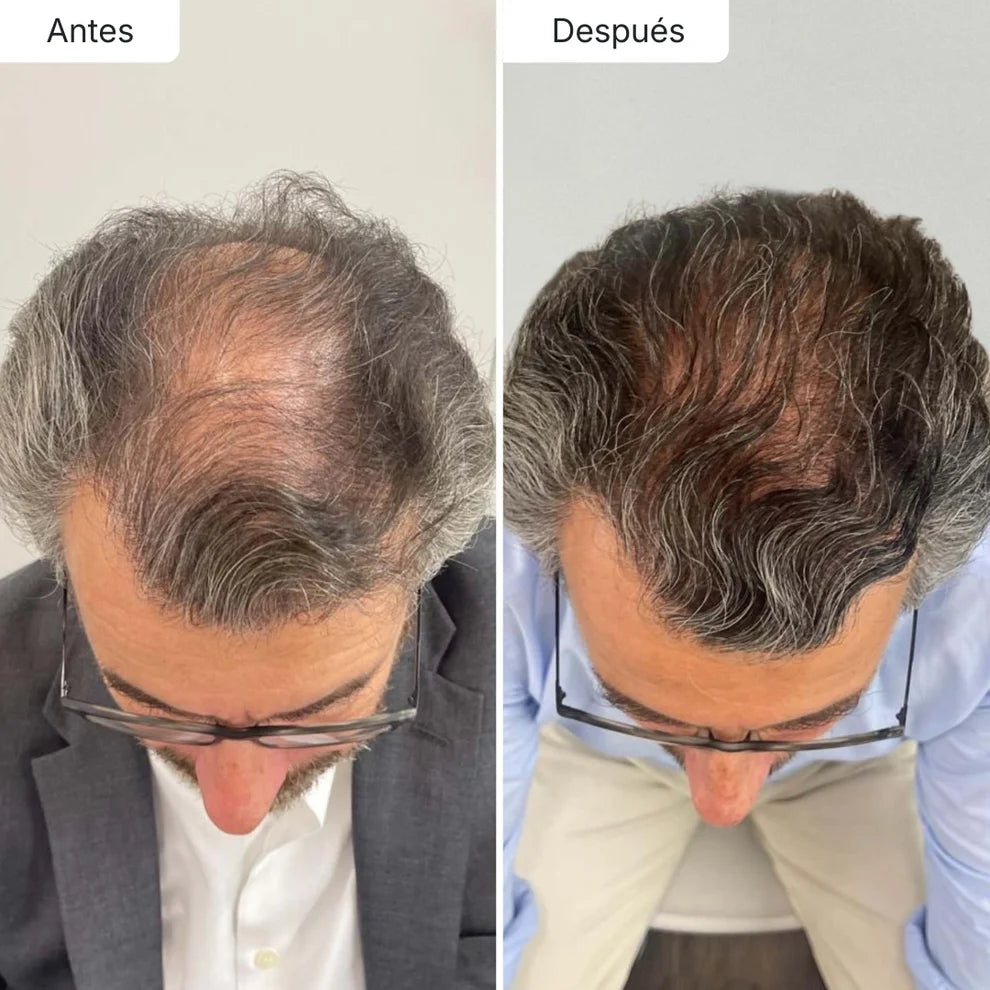 Sérum Anticaída de Doble Acción | Retoma tu pelo de hace años!