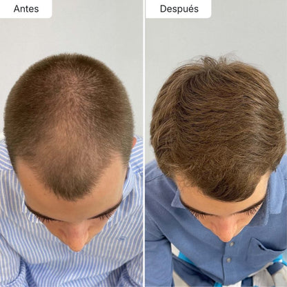 Sérum Anticaída de Doble Acción | Retoma tu pelo de hace años!